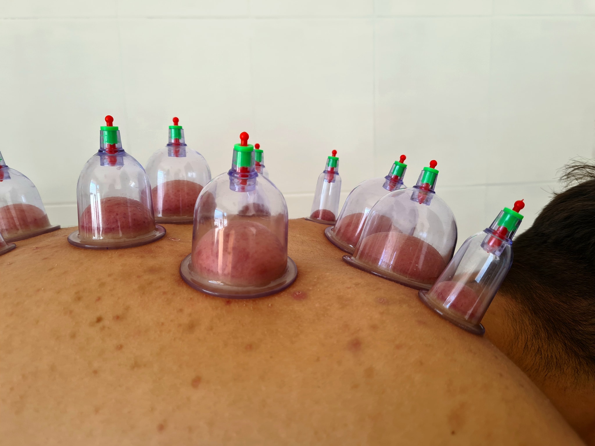 Terapie cu ventuze pe spate — tratament de recuperare medicală PKR Enjoy Kineto